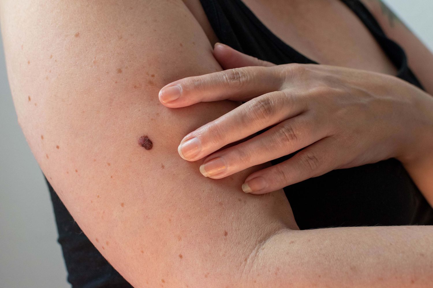 If You Have A Mole At One Of These 7 Places On Your Body This Is What It Means.