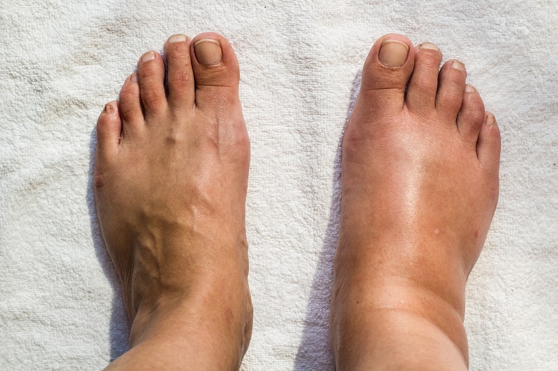 9 Alarming Warning Signs of Swollen Feet You Should Never Ignore