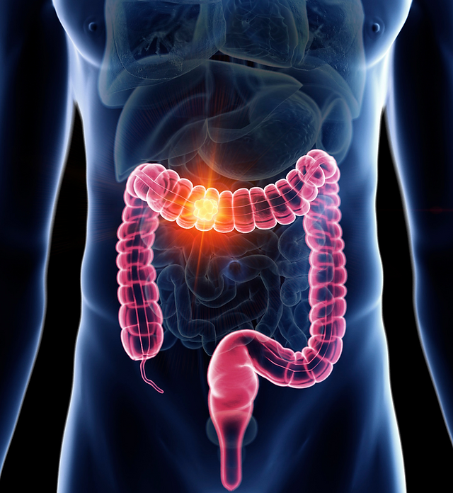 Discover a Powerful Natural Laxative to Cleanse Your Colon in Just One Day!