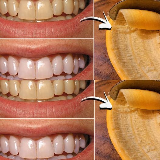 Enhance Your Smile Naturally with Banana Peels