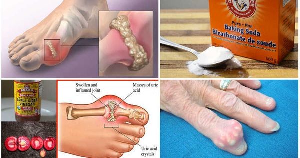 How to Remove Uric Acid Crystallization from Your Body and Prevent Gout and Joint Pain