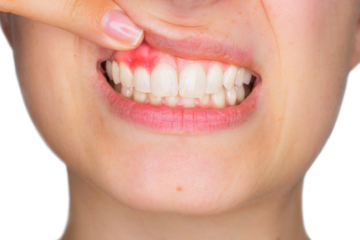 Receding Gums: A Natural Approach to Healing and Sensitivity Relief