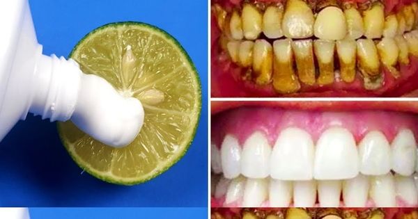 Brighten Your Smile Naturally: The Two-Minute Lemon Whitening Method