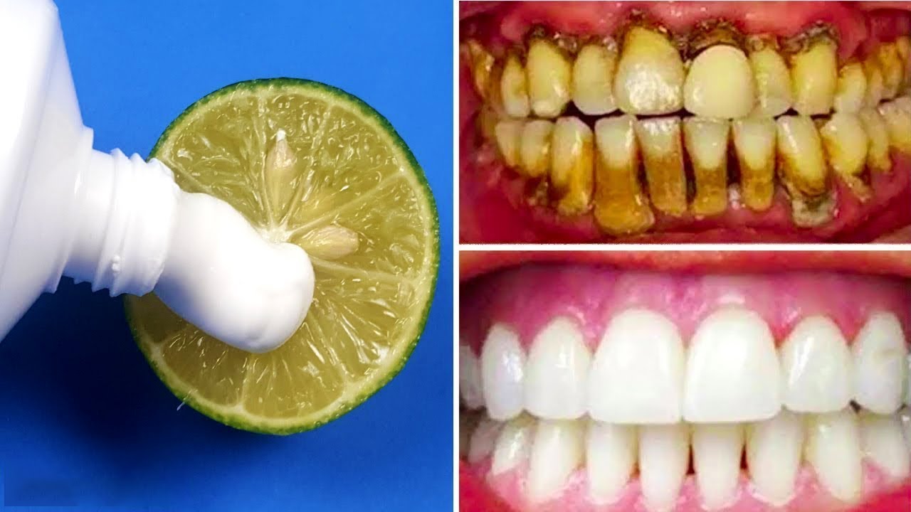 Brighten Your Smile Naturally: The Two-Minute Lemon Whitening Method