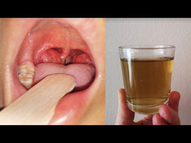 Vanquish Throat Pain and Inflammation in Just One Day with These Simple Recipes!