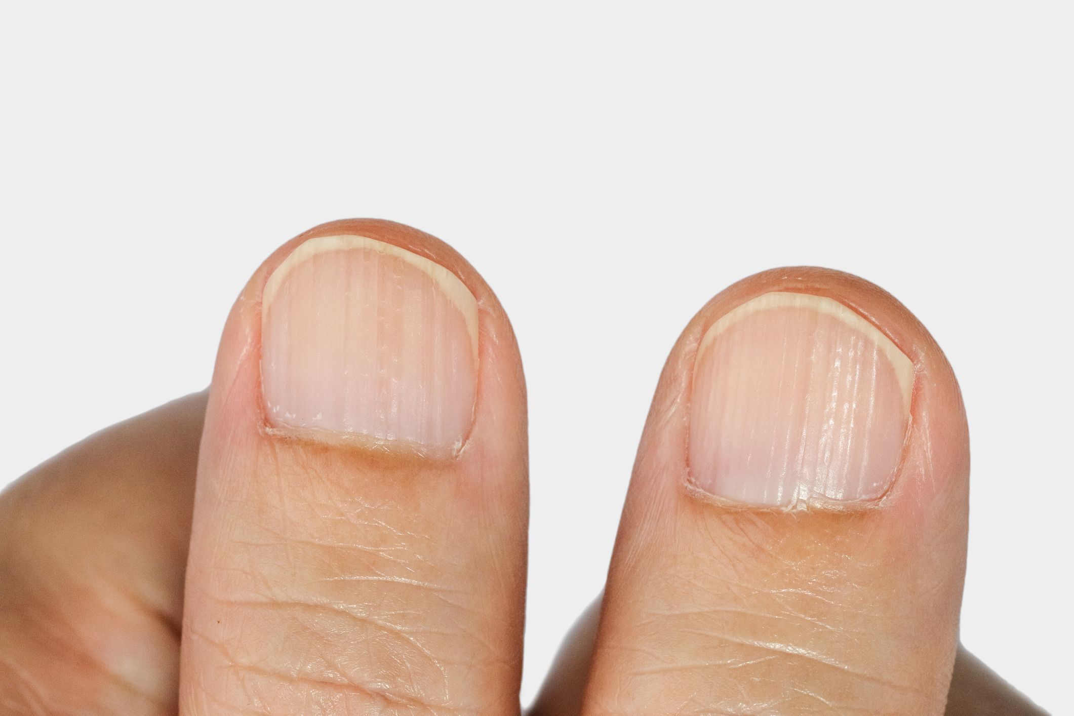 Unveiling the Mystery Behind Vertical Ridges on Nails