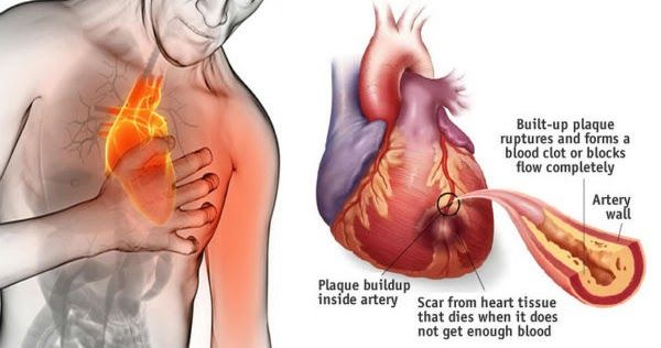 How to Stop a Heart Attack in Just 60 Seconds with Cayenne Pepper