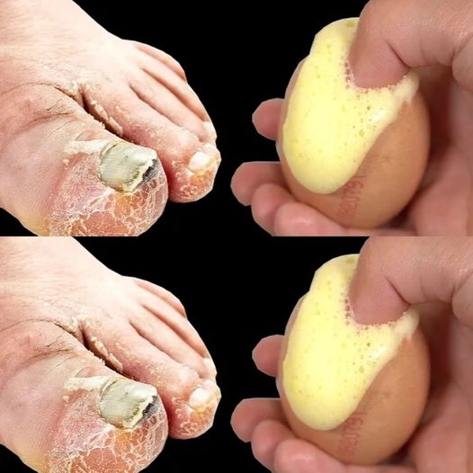 An Easy and Affordable Solution for Toenail Fungus