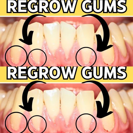 Receding Gums: Natural Strategies for a Healthy Smile