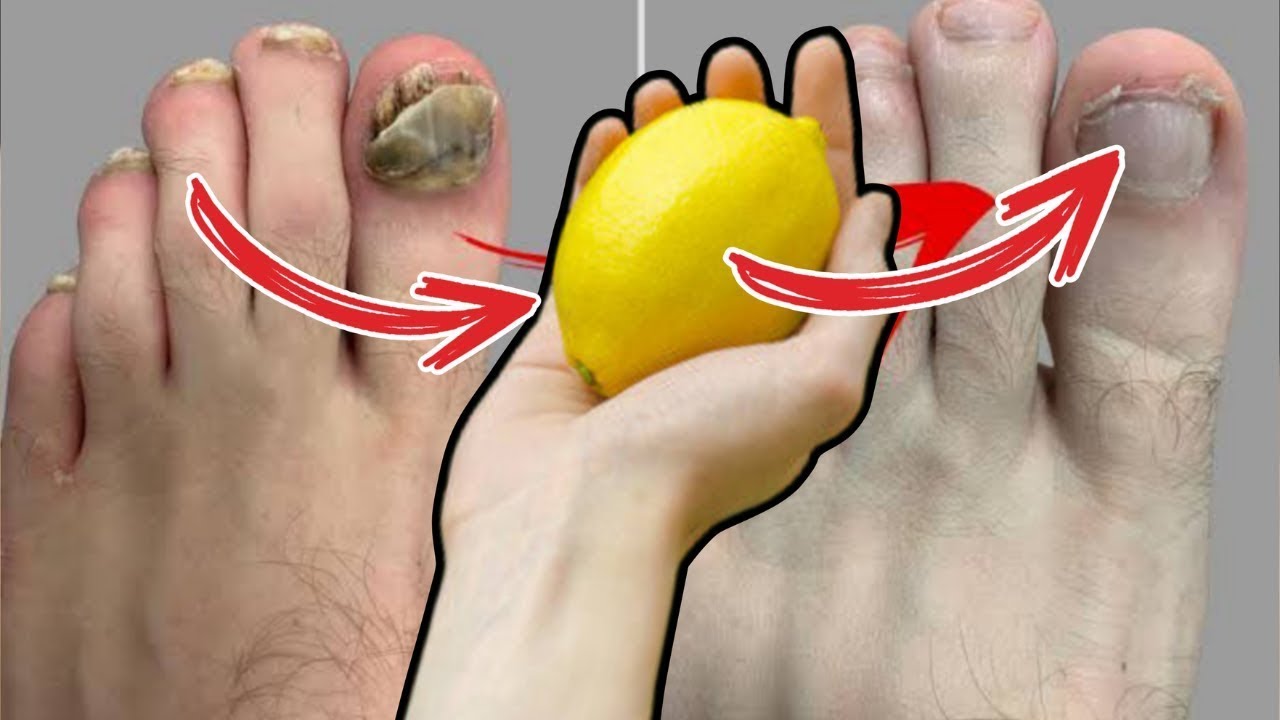 Say Goodbye to Toenail Fungus with Lemon: A 100% Natural Treatment