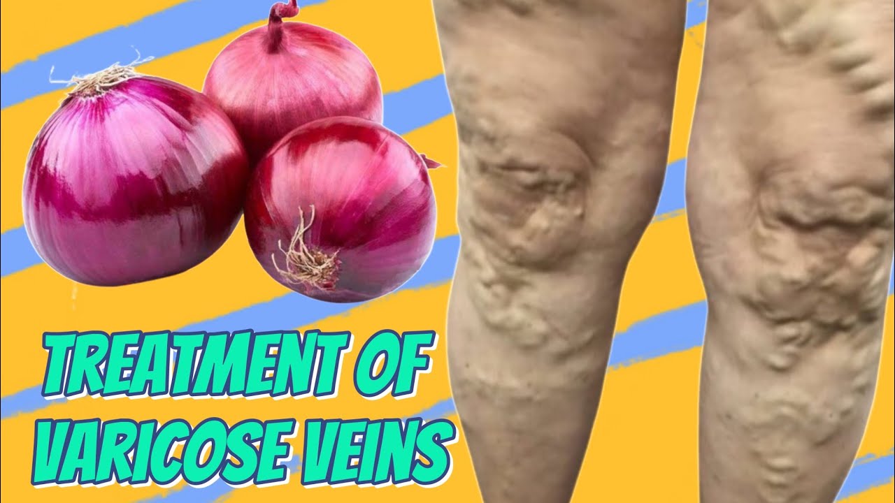 A Gentle Guide to Varicose Veins and Onions: Navigating Through Myths and Facts