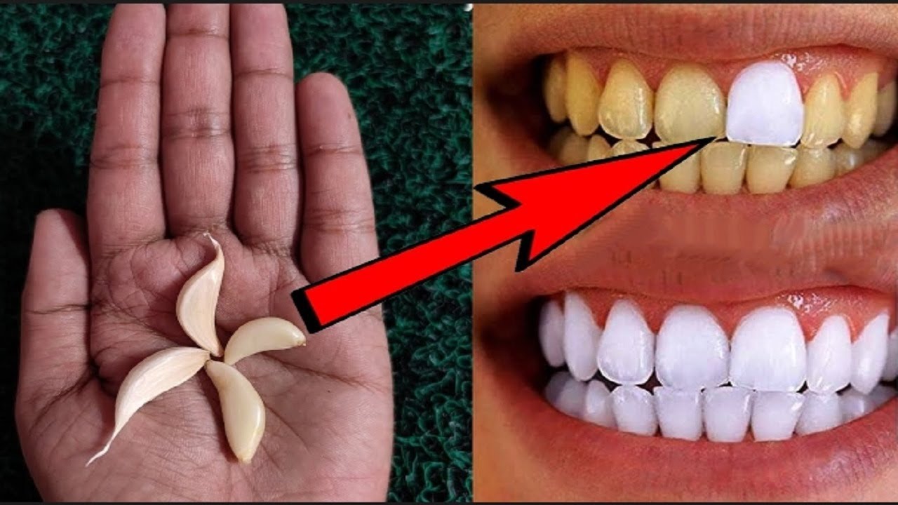 Unlock the Secret to a Brighter Smile with Garlic