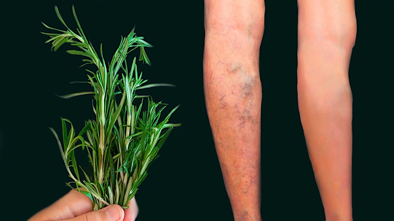 Rosemary: A Natural Gem for Vanishing Varicose Veins