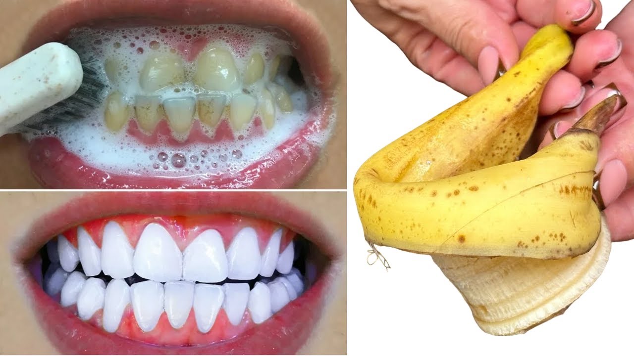 Unlock a Pearl White Smile in Just 1 Minute: The Banana Peel Miracle