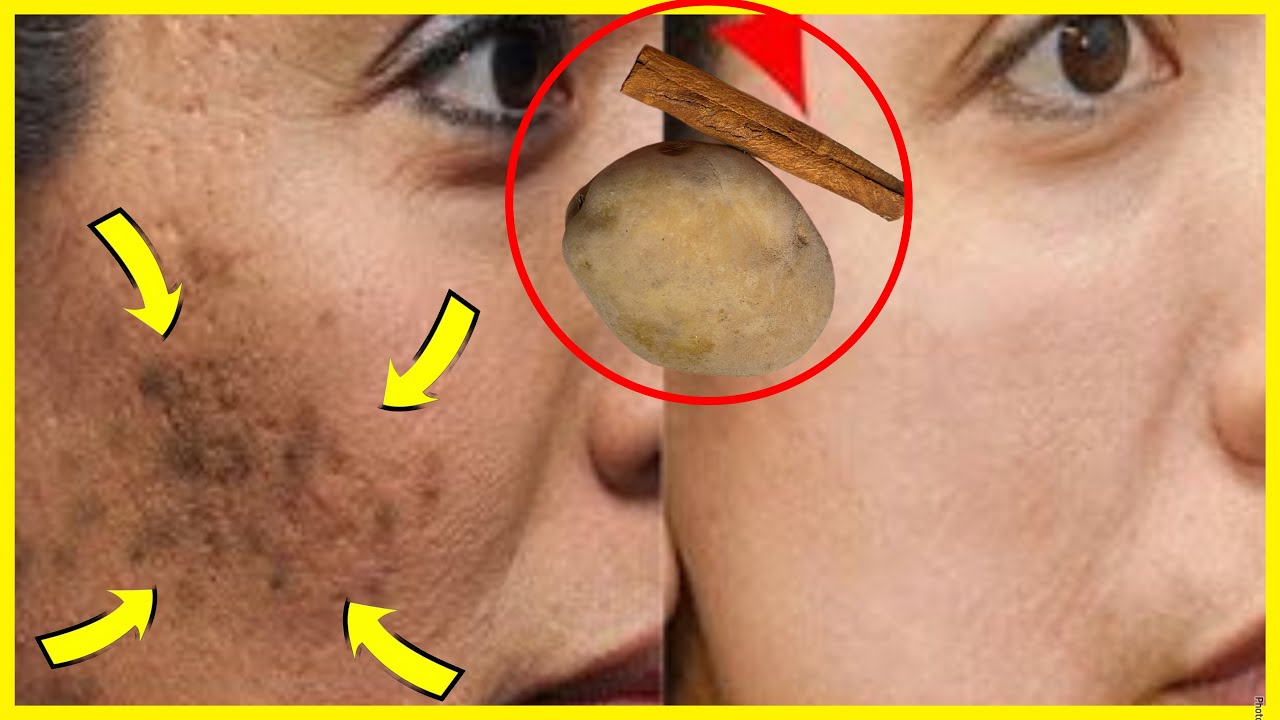 Natural Glow: Banishing Sun Spots with Potato and Cinnamon