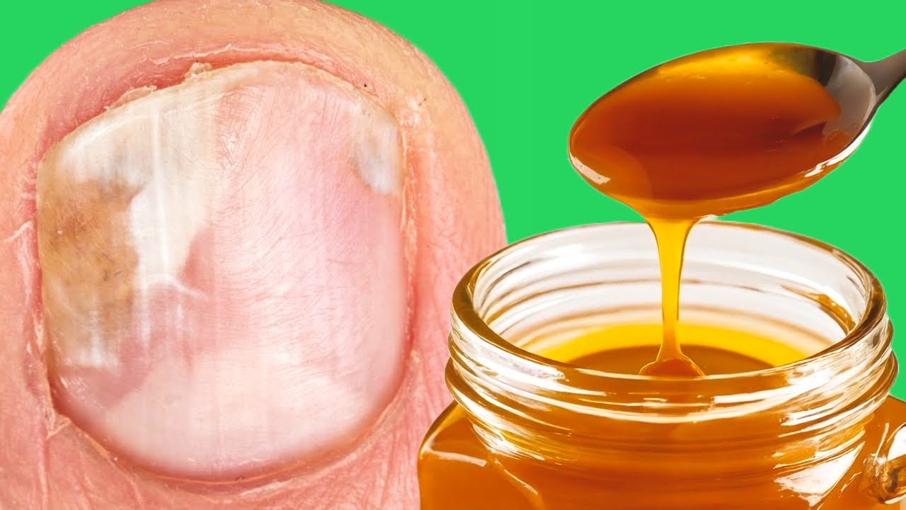 The Ultimate Trio: Top 3 Home Remedies to Bid Farewell to Toenail Fungus