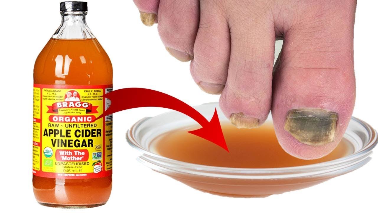 Wave Goodbye to Toenail Fungus with a Natural Apple Cider Vinegar Remedy