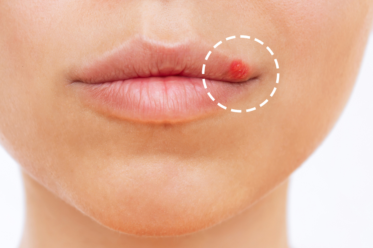 Navigating Herpes with Natural Remedies: A Gentle Approach