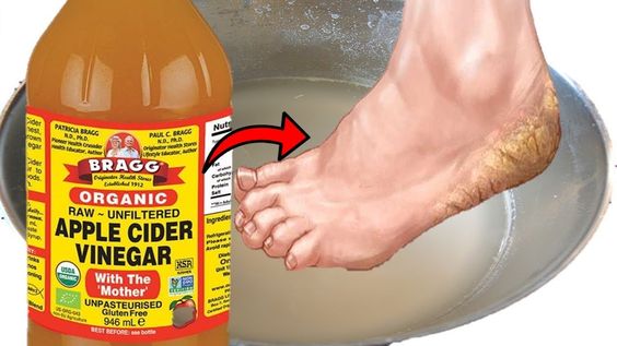 Unveiling the Benefits of Vinegar Soaks for Your Feet