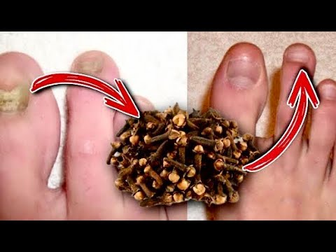 Natural Toenail Fungus Treatment with Cloves