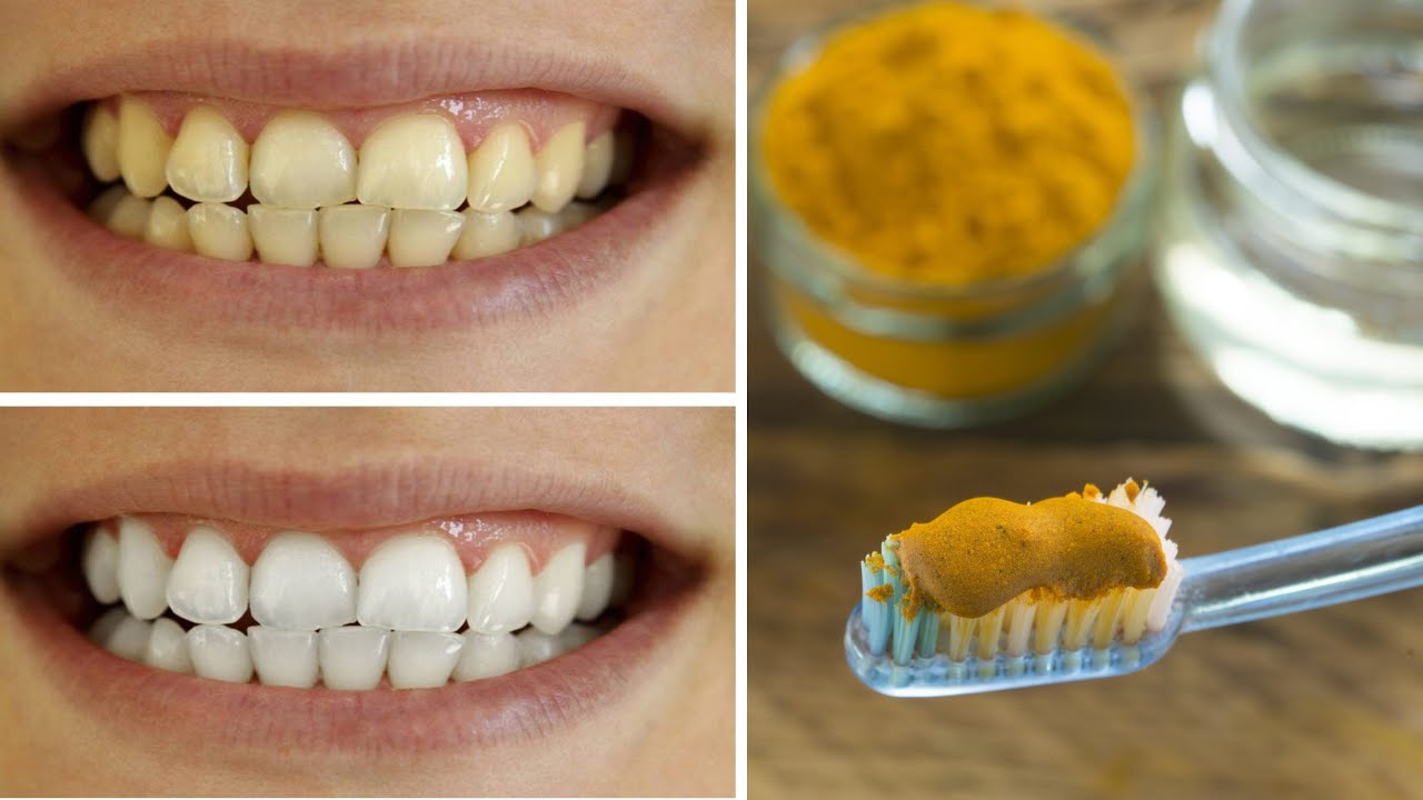 Discover the Natural Wonder of Turmeric for Dental Health