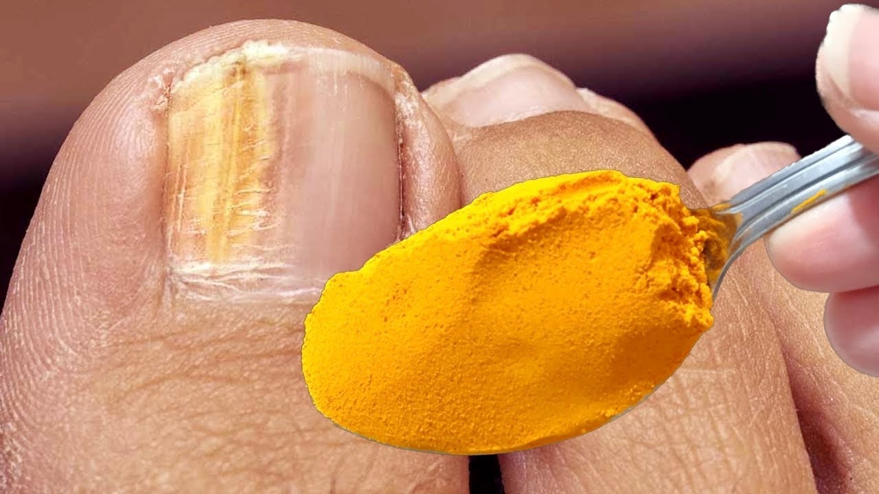 Nail Fungus Removal: The Natural Power of Turmeric