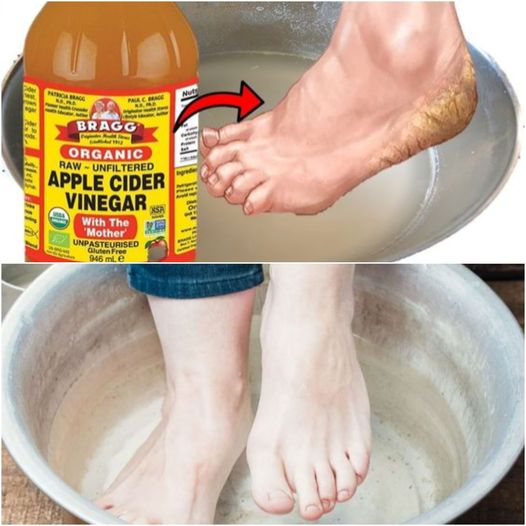 Dump Vinegar on Your Feet and WATCH WHAT HAPPENS