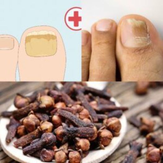 Nail Fungus Removal: 100% Natural Treatment for Toenail Fungus Using Cloves