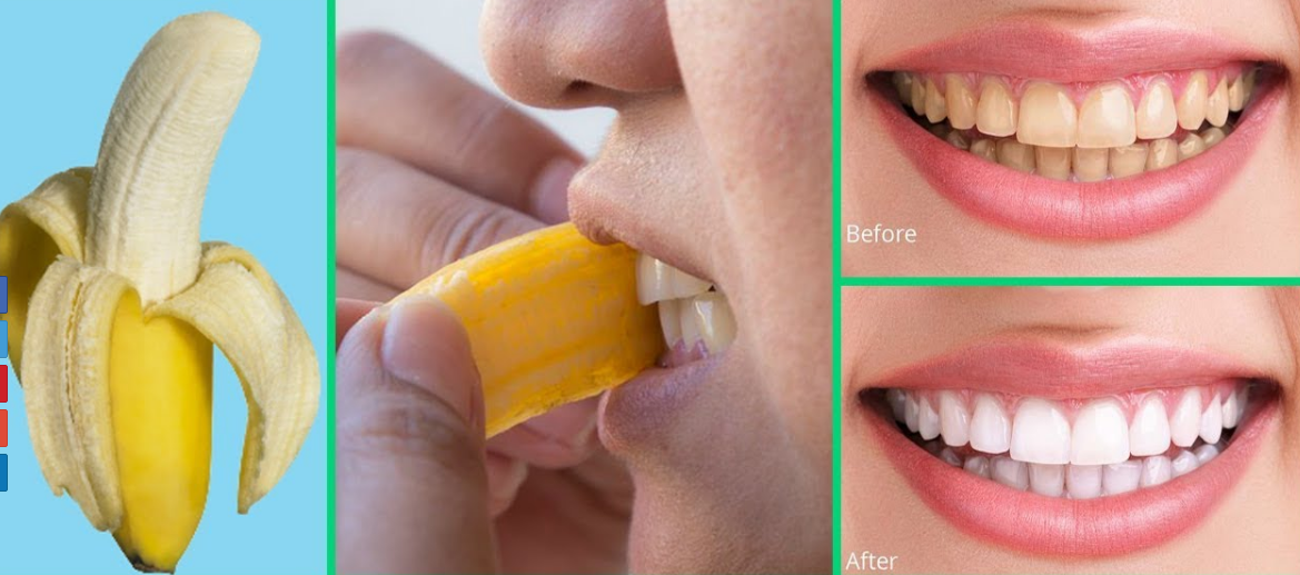 Secret That Dentists Don’t Want You to Know: Remove Tartar and Whiten Teeth in Just 2 Minutes with Banana Peel! 🪥🦷