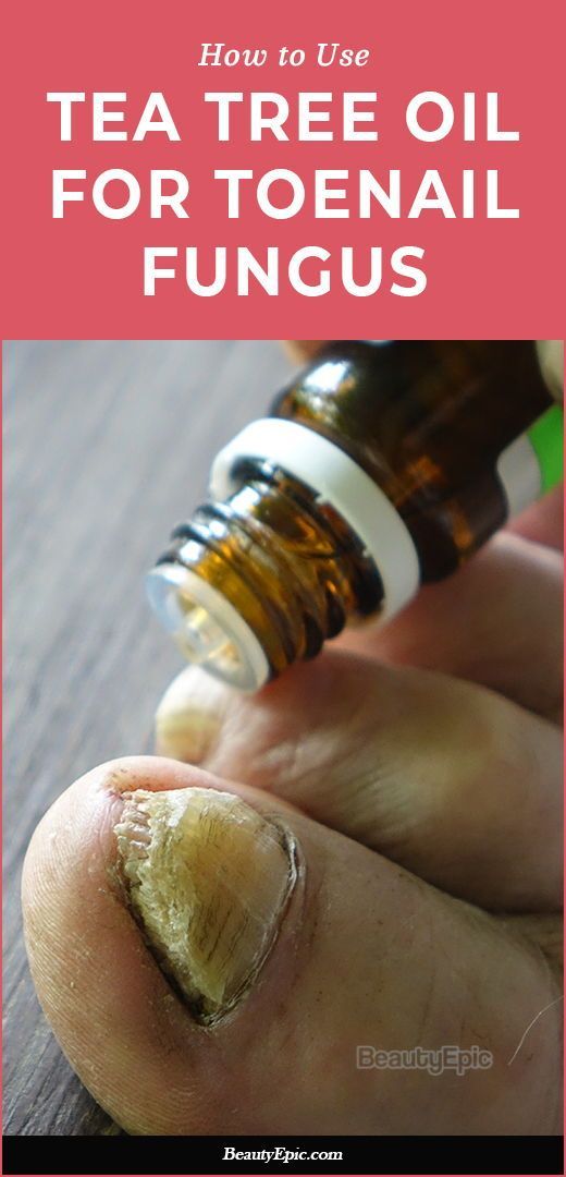 Discover the Miracle Solution: Essential Oils for Toenail Fungus