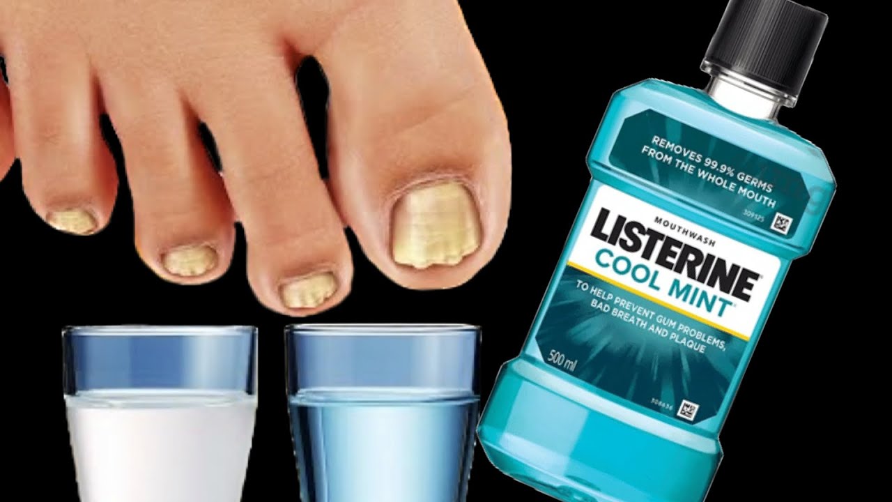 Say Goodbye to Toenail Fungus with This Natural Remedy: Mouthwash Magic!