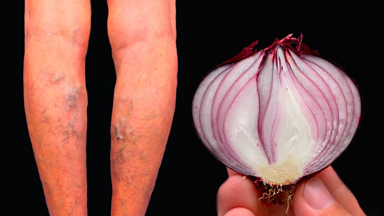 Unbelievable! 🤩 It’s a Varicose Vein Killer! Erases Varicose Veins Like an Eraser! Top 5 Recipes with Red Onion