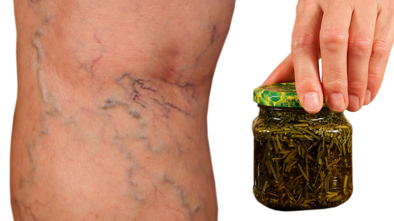 Incredible! Varicose Veins Disappear with the Help of Rosemary! A Treasure That Everyone Should Have