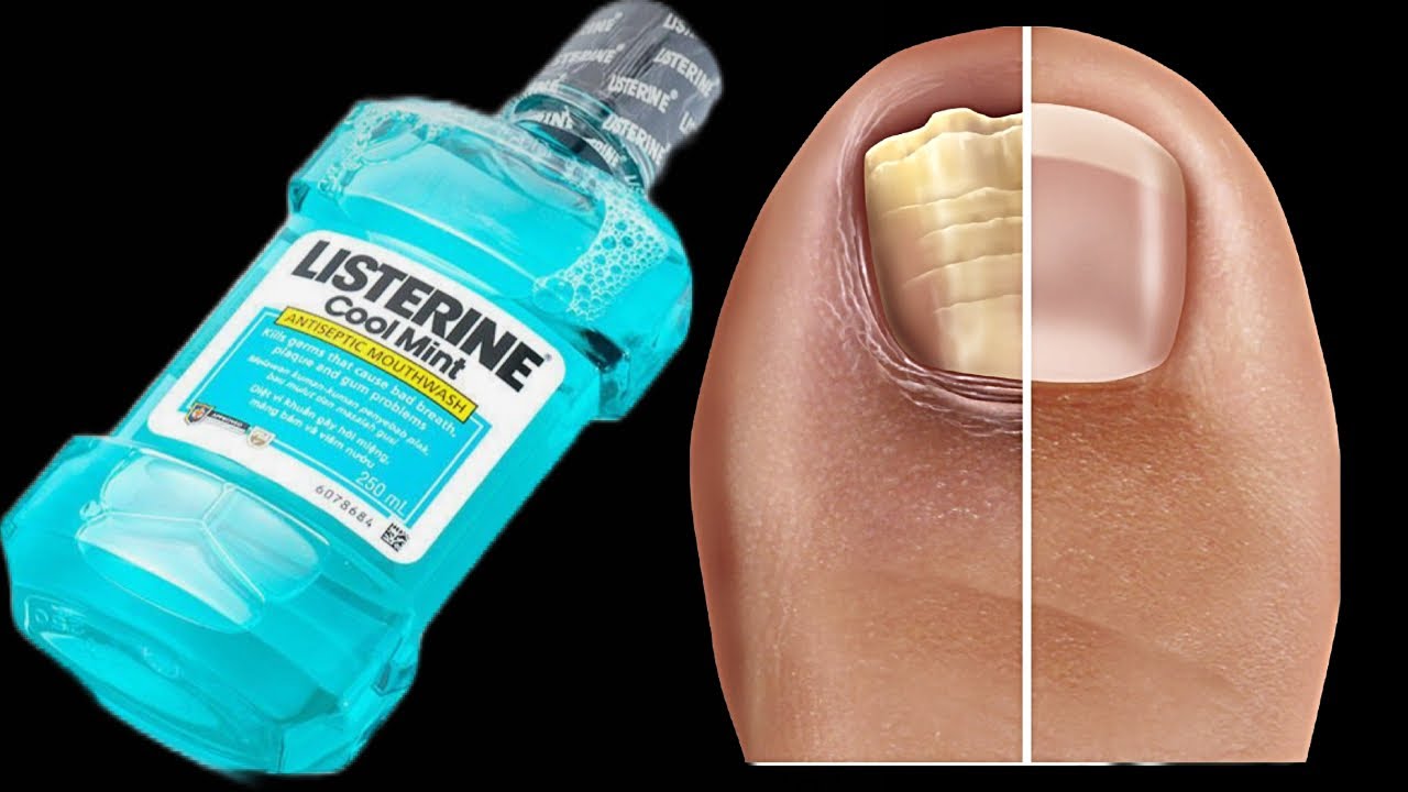 This Easy Recipe Will Get Rid of Nail Fungus – Forever! 💪