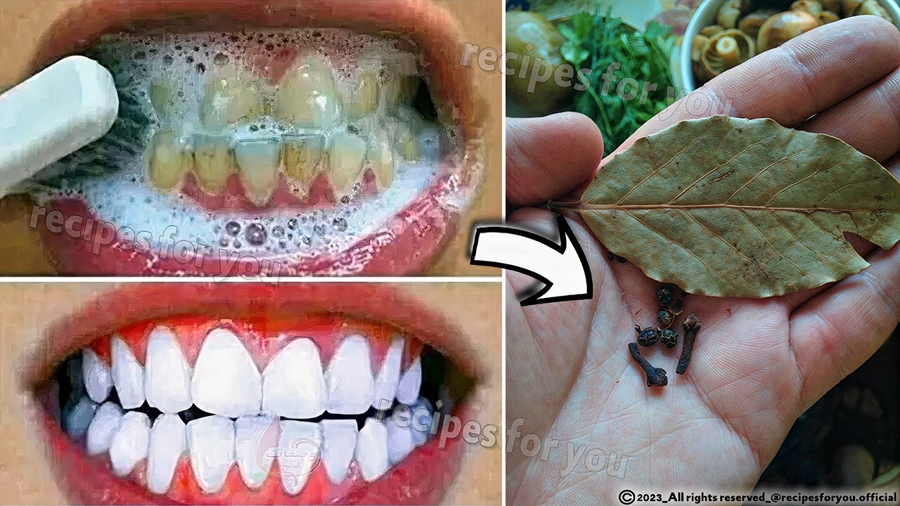 Secret That Dentists Don’t Want You to Know: Remove Tartar and Whiten Teeth in Just 2 Minutes with Cloves and Bay Leaves