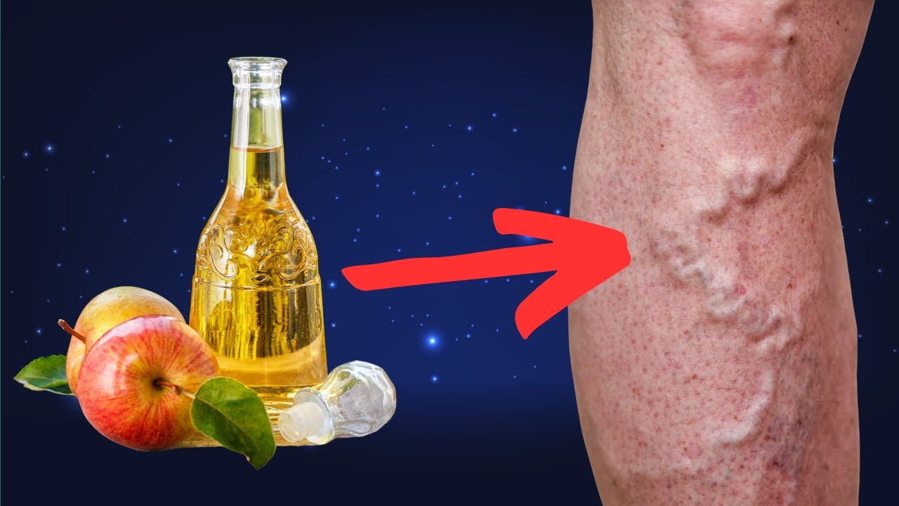 SHOCK! This is a Varicose Vein Killer! How to Treat Varicose Veins at Home with Apple Cider Vinegar