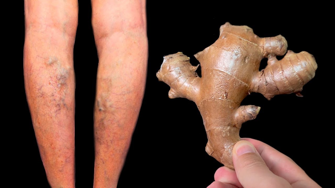 Say Goodbye to Varicose Veins and Joint Pain with Ginger: A Natural Solution