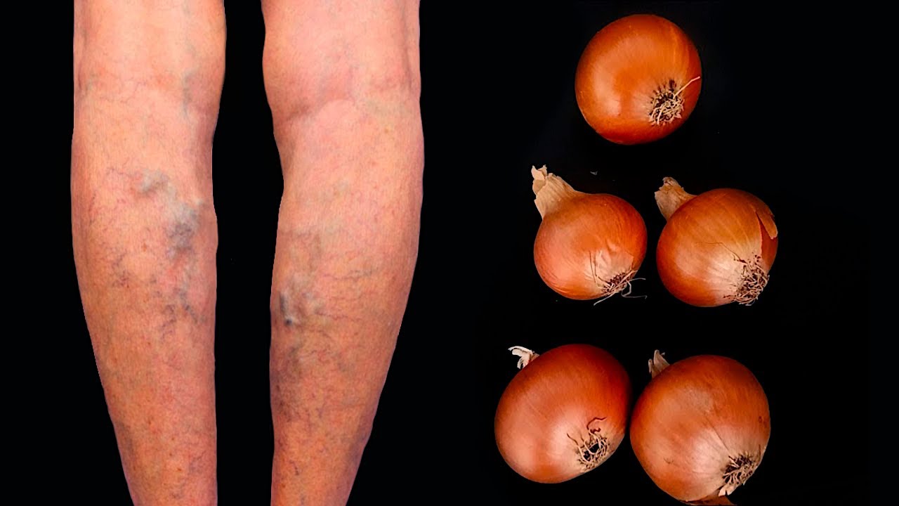 Discover the Natural Remedy for Varicose Veins: Onions, the Household Treasure