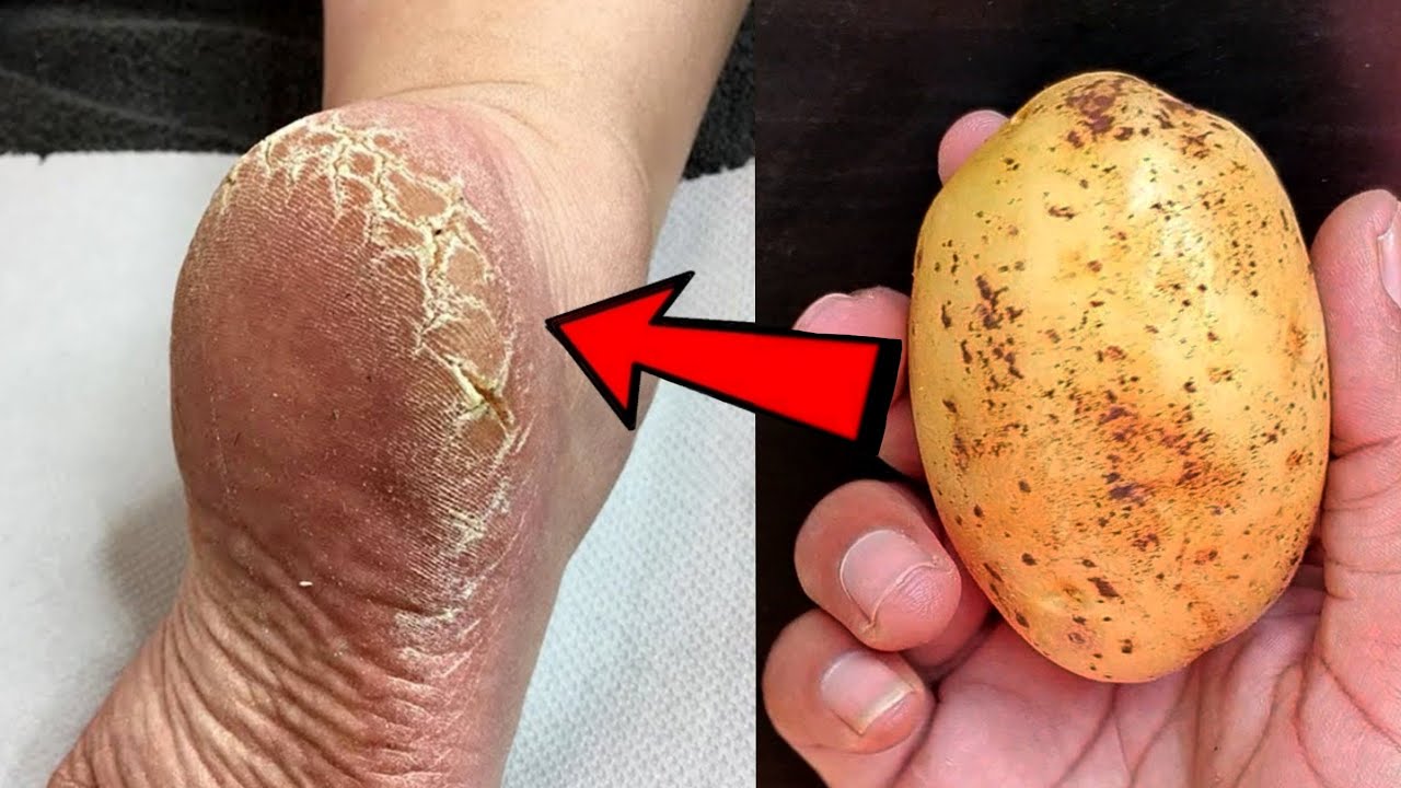 Eliminate Cracked Heels and Get White and Smooth Feet: Magic Cracked Heels Home Remedy with Potato