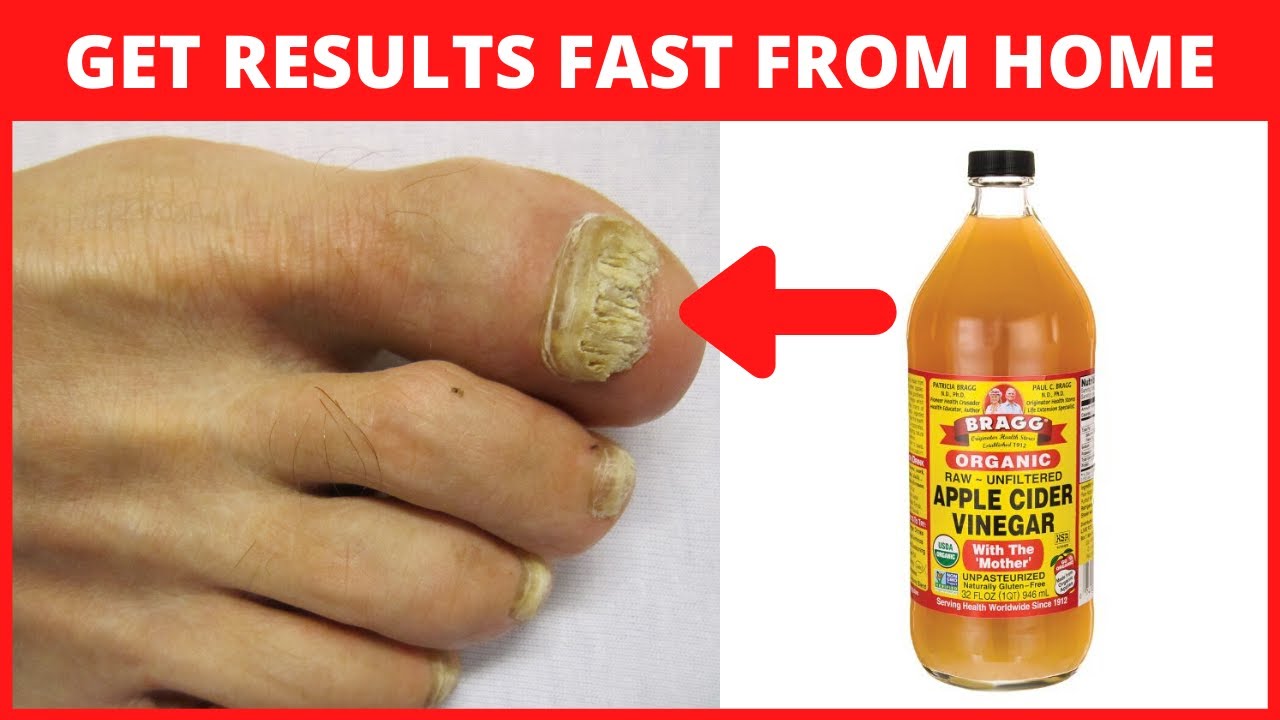 Say Goodbye to Toenail Fungus with This 100% Natural Vinegar Remedy