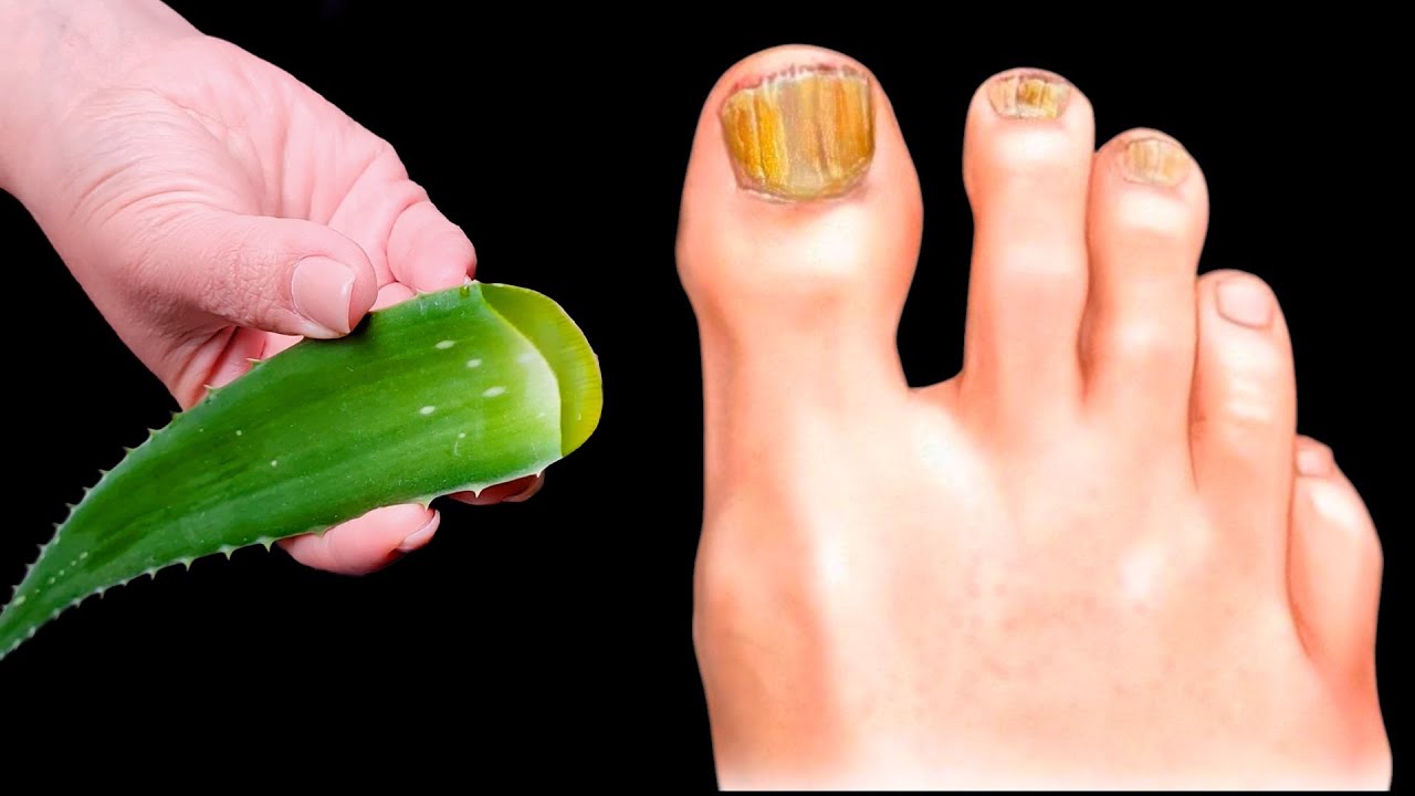 🔥 Eliminates Nail Fungus IMMEDIATELY! The Best Remedy! Benefits of Aloe! 🌿😍