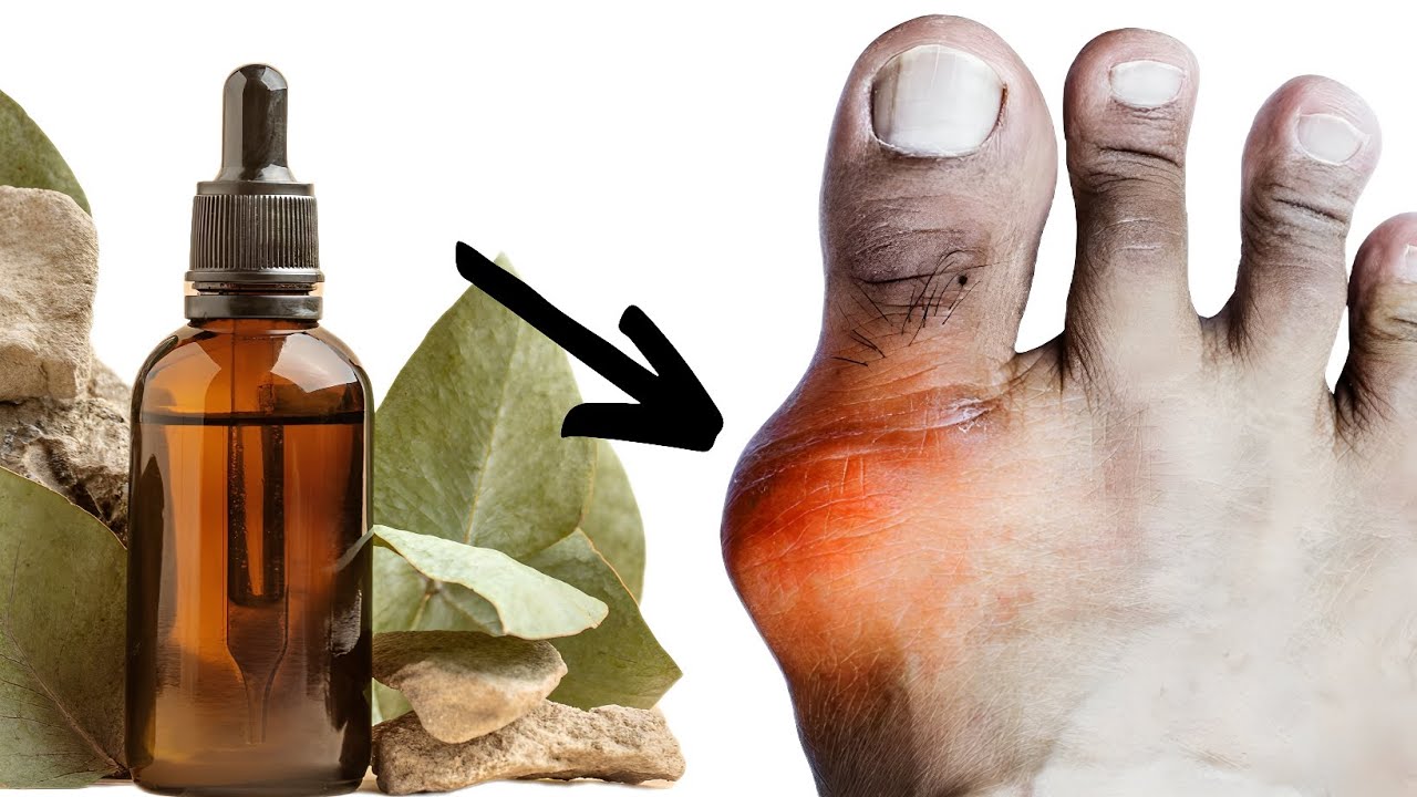 Amazing Oil Cures Gout! Removes Pain, Swelling, Redness…