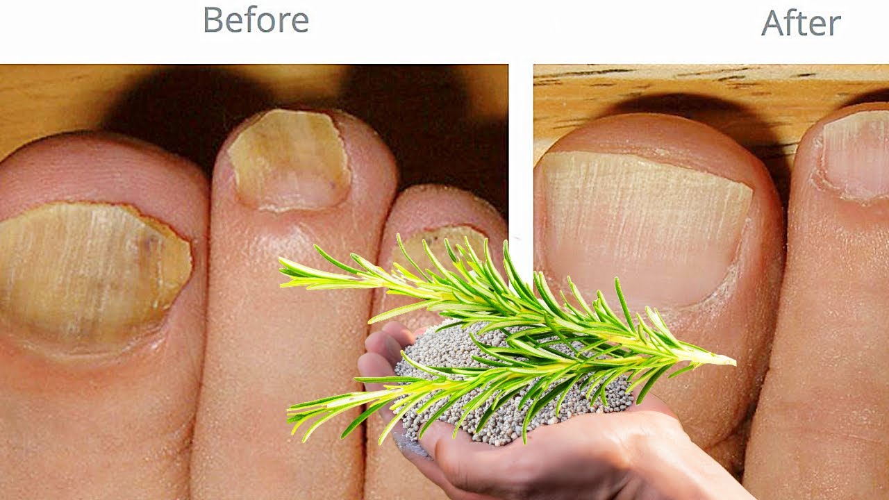 Rosemary: A Powerful Remedy Against Nail Fungus