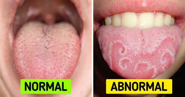 What is White Tongue and How to Treat It?