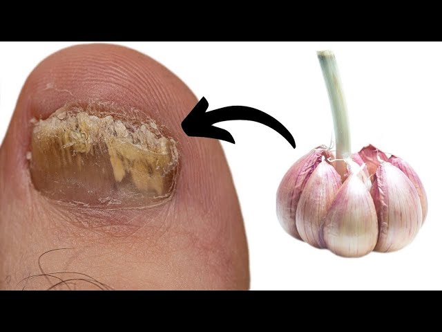 Garlic: A Natural Remedy for Fungal Foot Infections