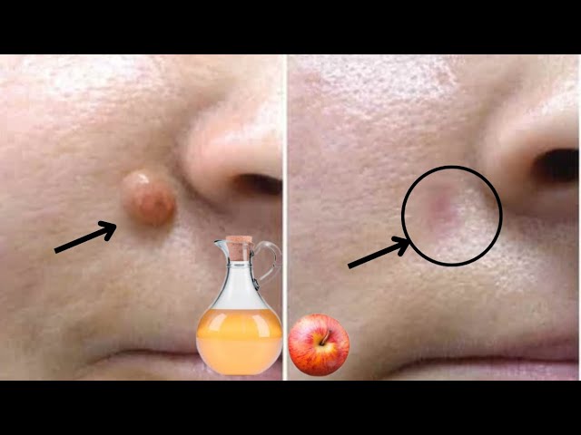 Apple Cider Vinegar: A Simple Solution for Removing Warts Quickly