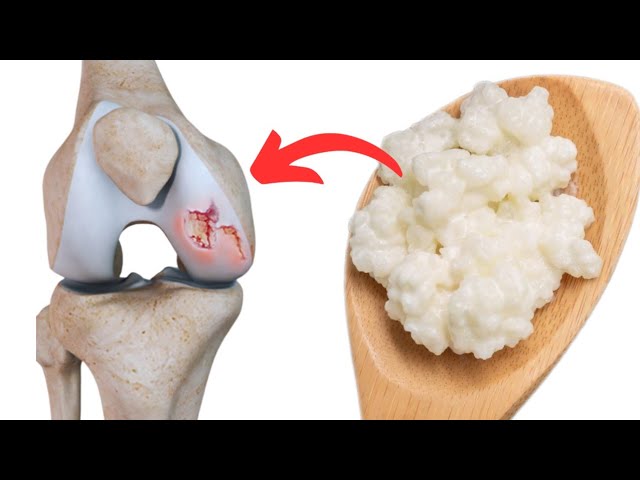 Food for the Renewal of Knee Cartilage: The Benefits of Kefir