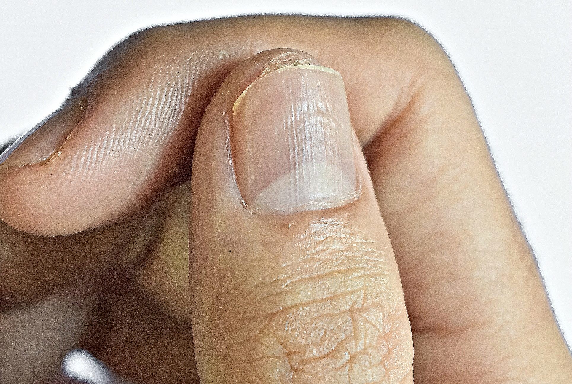 Understanding the Real Causes of Vertical Ridges on Your Nails