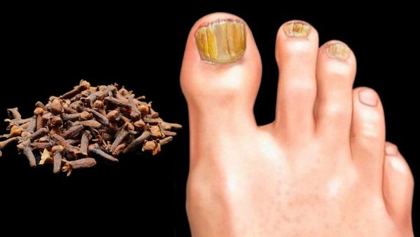 A Natural Solution for Nail Fungus