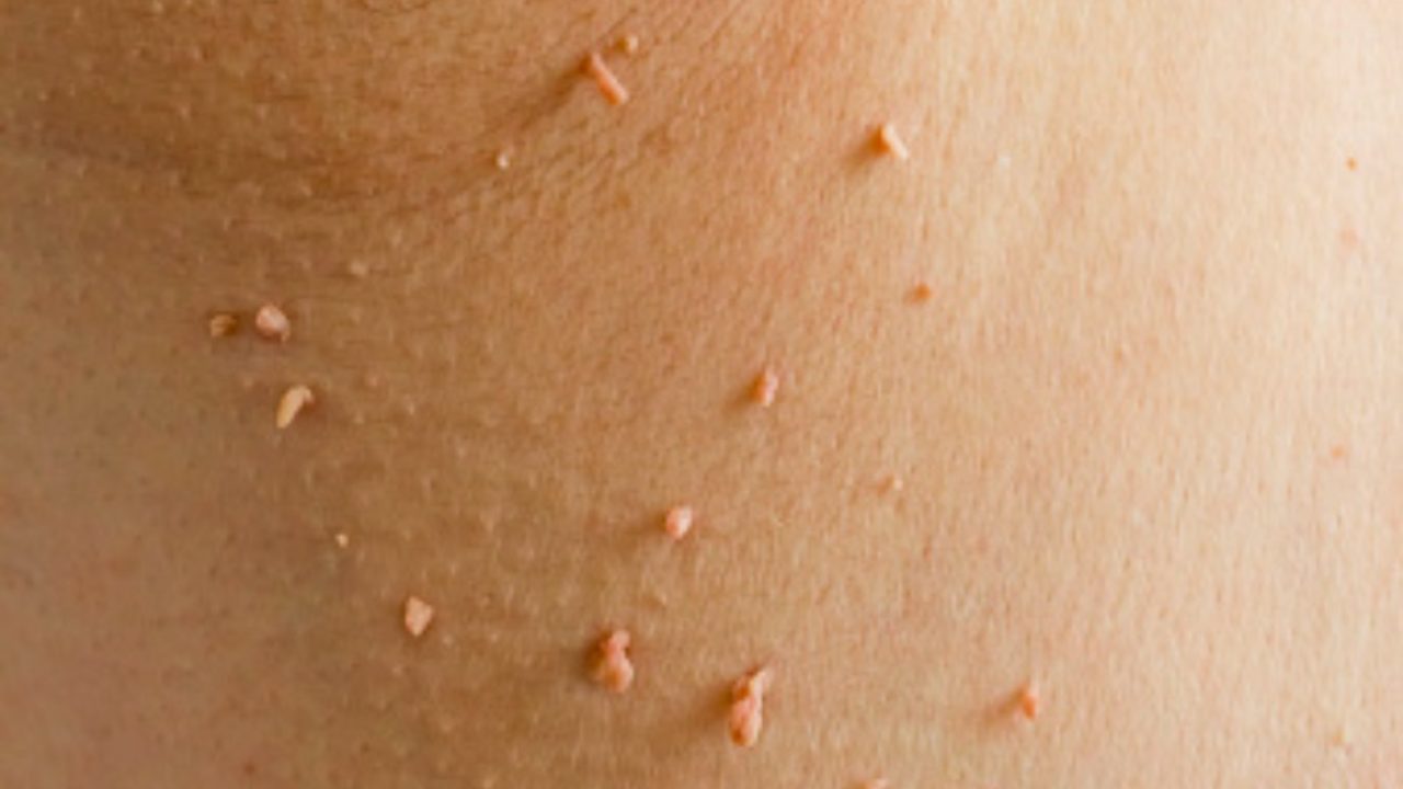 Easy Home Remedies for Skin Tags and Plantar Warts